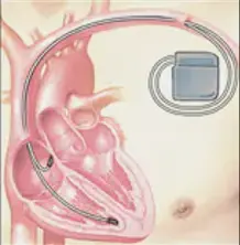 細數心臟起搏器和ICD之間的差異